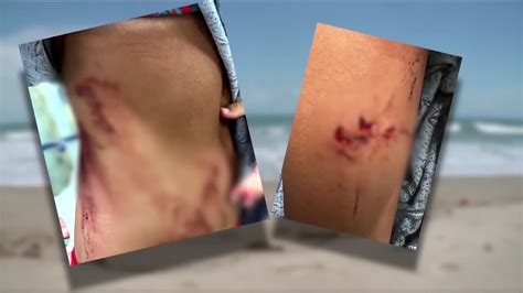 Florida girl survives shark attack, says it 'went straight to me'