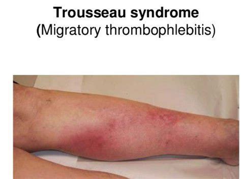 Treatment for Trousseau Syndrome - MEDizzy