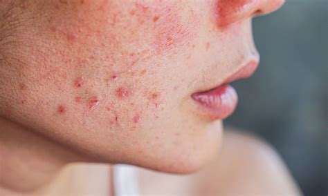 Rosacea Guide: Causes, Triggers and Treatment | Software