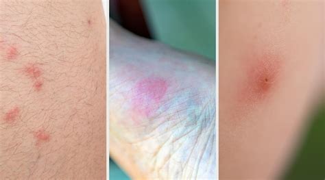 essbar Routine Beruhigen difference between flea and bed bug bites Auckland emotional Geizhals