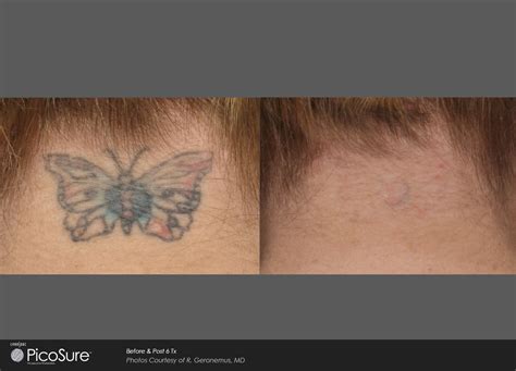 PicoSure Laser Tattoo Removal | Mansfield Cosmetic Surgery Center