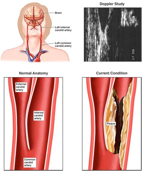 What is carotid artery disease?