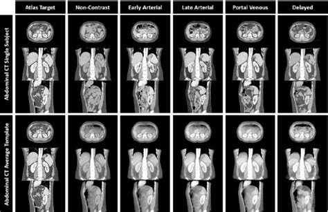 Construction of a Multi-Phase Contrast Computed Tomography Kidney Atlas ...