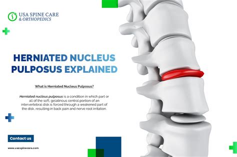 Herniated Nucleus Pulposus Explained - USA Spine Care - Laser Spine Surgery