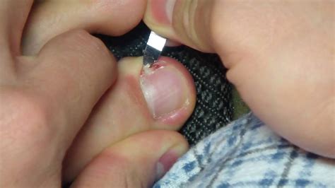 2nd attempt at removing ingrown toenail - YouTube