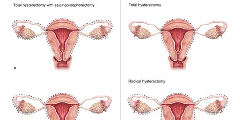 8 Ways I Coped With Having a Hysterectomy at 23 | The Mighty