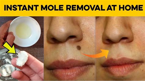 How To Remove Moles On Skin At Home - HOWTORMEOV