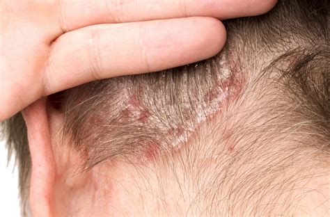 Early Signs of Scalp Psoriasis: How to Recognize and Manage Them ...