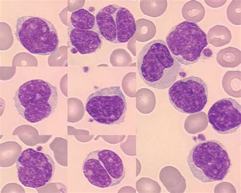 Mantle cell lymphoma - MEDizzy