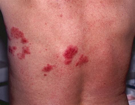 Early stage shingles rash – Libracha