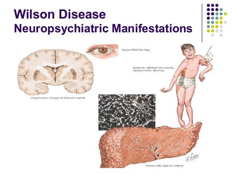 Wilsons disease