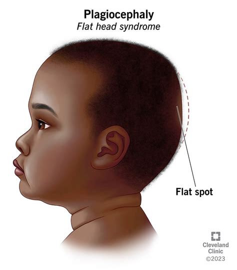 Plagiocephaly, Positional Plagiocephaly, Flat Head Syndrome: Causes ...