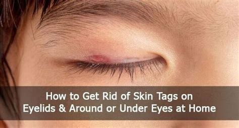 How To Remove Skin Tag On Eyelid At Home Quickly - Health - Nigeria