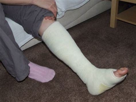 Cast Kit - Short Leg - Plaster - A-1 Medical Integration