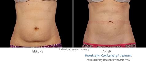 coolsculpting_before_and_after_result_numaspa_2 - Numa Spa