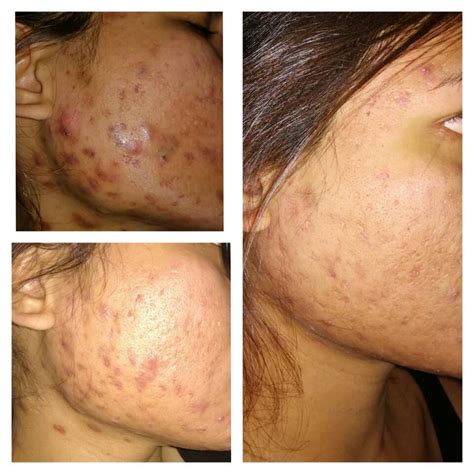 cystic acne before and after – Adult acne – Acne.org Forum