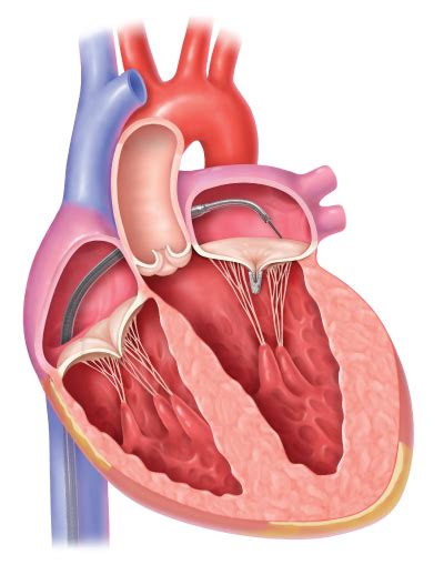 Mitral Transcatheter Edge-to-Edge Repair (TEER) | Conditions & Treatments | UCSF Health