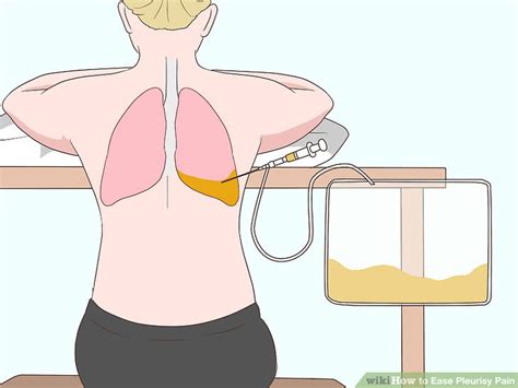 How to Ease Pleurisy Pain: 8 Steps (with Pictures) - wikiHow