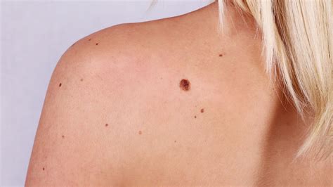 What Skin Cancer Moles Look Like