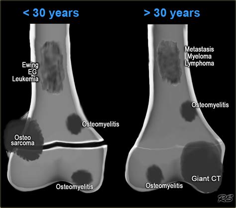 The Radiology Assistant : Bone tumor - Osteolytic tumors and tumor-like lesions (ill defined)