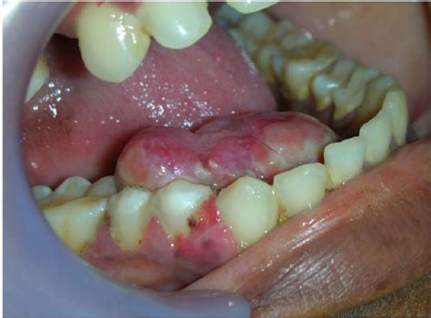 Peripheral ameloblastoma of gingiva with cytokeratin 19 analysis | BMJ ...