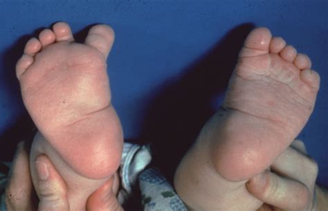 Metatarsus Adductus - Pediatrics - Orthobullets