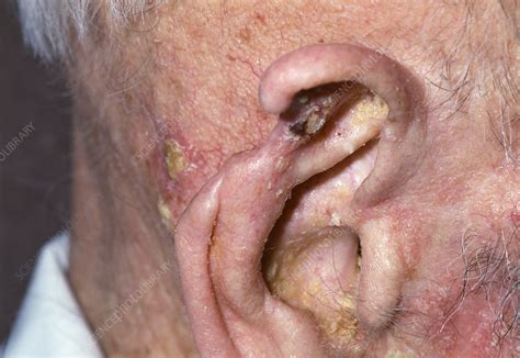 Ear after cancer treatment - Stock Image - M131/0502 - Science Photo Library