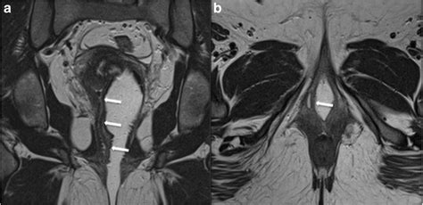 Vaginal septum revealed by MRI. T2W TSE coronal (a) and axial (b ...