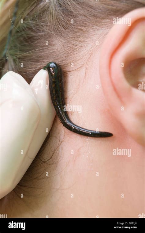 Hirudo therapy. Leech therapy. Hirudinea medicinal. Healer apply leech on the patientś body ...