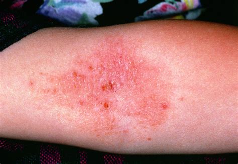 Close-up Of Eczema In The Crook Of The Elbow Photograph by Dr H.c.robinson/science Photo Library