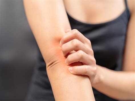 Spongiotic Dermatitis: Symptoms, Causes, Treatment & Prevention - Boldsky.com