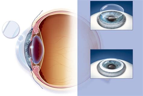 How the Cornea Is Important for Our Vision