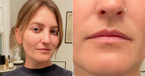 I Tried Cheek Filler: See Before and After Photos | POPSUGAR Beauty UK