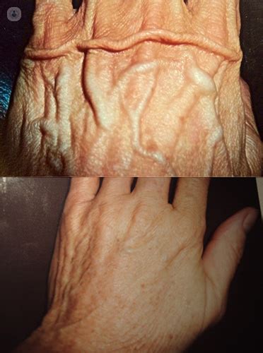 Is it possible to remove bulging veins in the hand?