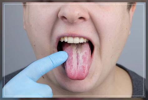 Oral Thrush: Symptoms, Causes, and Treatment - REPC