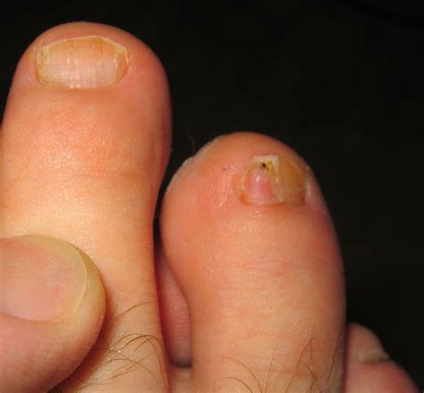 Types of toenail fungus - Awesome Nail