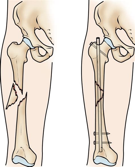 Femur Shaft Fractures (Broken Thighbone) - OrthoInfo - AAOS