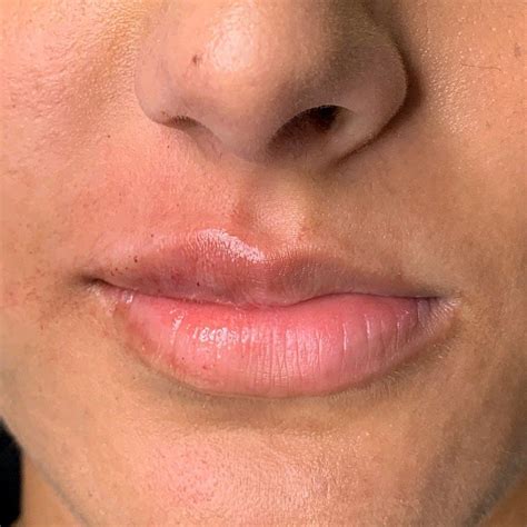 This is a split image of the before and after of a clients first lip enhancement... | Lip ...