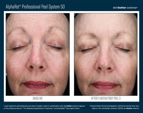 Chemical Peels - Swan Center for Plastic Surgery