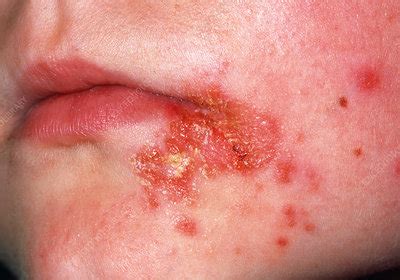 Impetigo skin infection - Stock Image - M180/0096 - Science Photo Library