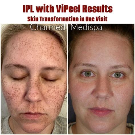 IPL With ViPeel Results – Our Favorite Same Day Treatment Combination ...