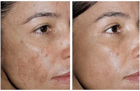 hydroquinone before after - pictures, photos