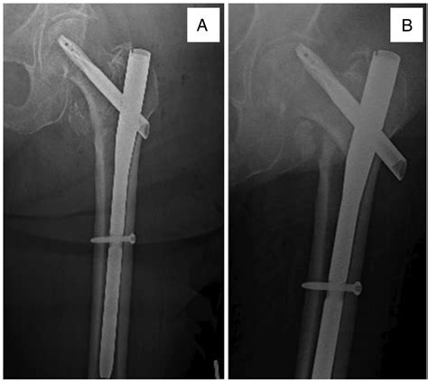 Outcomes After Revision Fixation With Cement Augmentation for Failed Intertrochanteric Fracture ...