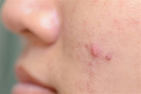 Acne Vulgaris, Scars & Treatments in Singapore