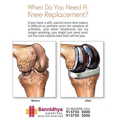 Knee Replacement – Sannidhya Multi-Specialty Hospital