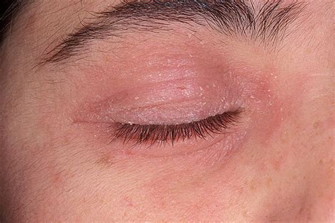 Learn About Eyelid Dermatitis Including Types Causes - vrogue.co