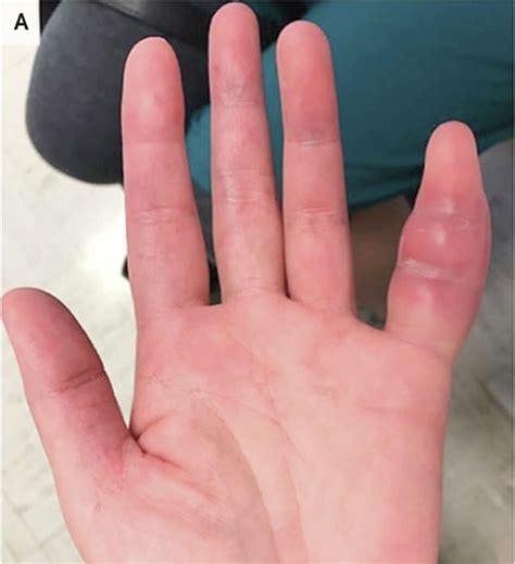 Woman's swollen pinky finger was rare sign of tuberculosis, UCSF doctors say