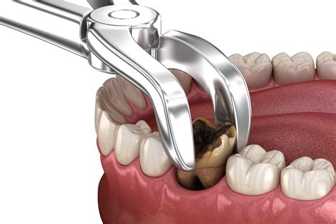 Tooth Extraction | Monahan Family Dentistry