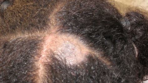 Details more than 82 hair diseases names with pictures super hot - ceg.edu.vn