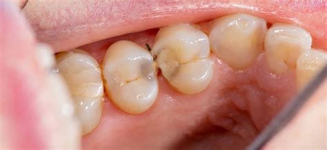 Cavities Between Teeth